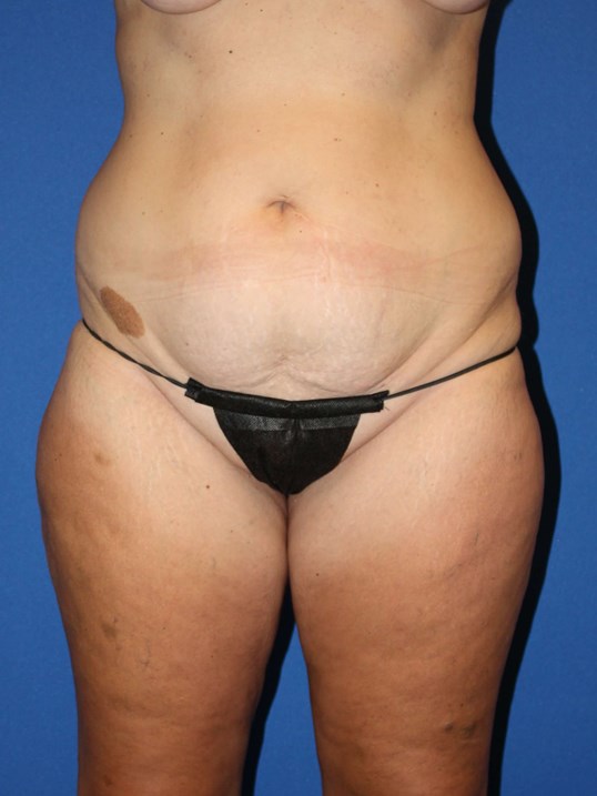 FUPA Liposuction in Colorado Springs